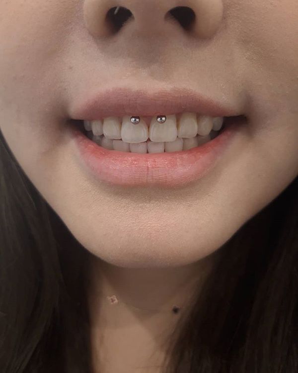 smiley piercing with braces